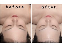 ポノ(PONO)/エアバリで美白ケア