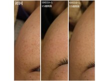 ベビースキン(baby skin)/シミ改善