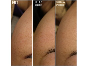 ベビースキン(baby skin)/シミ改善