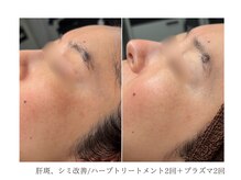 ルーム(room)/ハーブ2回＋プラズマ2回