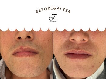 ナナ(nana)の写真/なかなか一歩踏み出せない方必見！痛みが少ないヒゲ脱毛で清潔感＆美肌へ♪