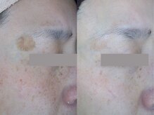サロンドアモール(Salon de a mole)の雰囲気（何歳になっても肌は変わる！シミしわケア/法令線/たるみ/毛穴◎）