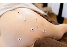 のはり/はり灸施術