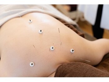 のはり/はり灸施術