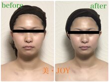 美 ジョイ(美 JOY)/小顔コルギ　施術例