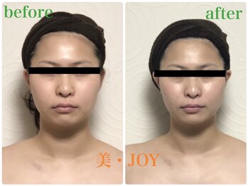 美 ジョイ(美 JOY)/小顔コルギ　施術例