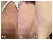 ミースプラス(me,as+)の雰囲気（脱毛しながらビタミン導入で美肌ケア［毛穴縮小脱毛］）