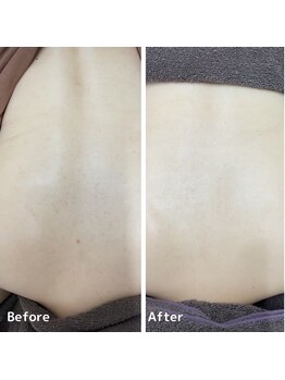 ニキビケア研究所 本厚木店/ブライダルエステにもオススメ!