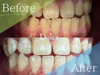 ドルチェ(Dolce)/ビフォーアフター
