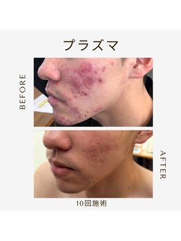 ツヤハダコガオ 千葉店/before⇒after 【プラズマ】