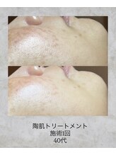 コンクパール(CONCH PEARL.)/陶肌トリートメント