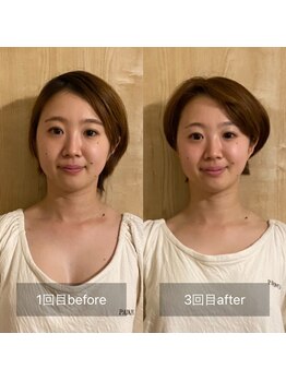 ブルースター(BlueStar)の写真/お顔のむくみが取れて小顔を目指す◎極上の脳洗浄ヘッドスパで整う時間♪