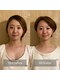 ブルースター(BlueStar)の写真/お顔のむくみが取れて小顔を目指す◎極上の脳洗浄ヘッドスパで整う時間♪