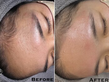 エヴァワックス 銀座店(Eva Wax)/ビフォーアフター【おでこ/額】