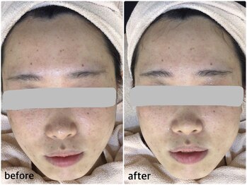 ザ フェース 京都御池店(THE FAITH)/一度のお肌変化