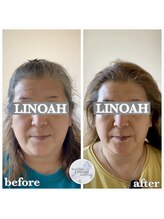 リノア 心斎橋店(LINOAH)/ウルトラプラス小顔リフト b→ a