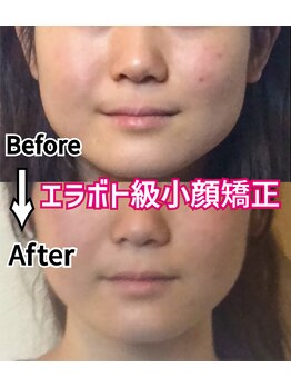 アコルデ 岡山問屋町(ACORDE)/小顔矯正ver.2