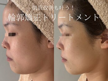 ラシュール(Rassure)/フォーエバーヤングbefore/after