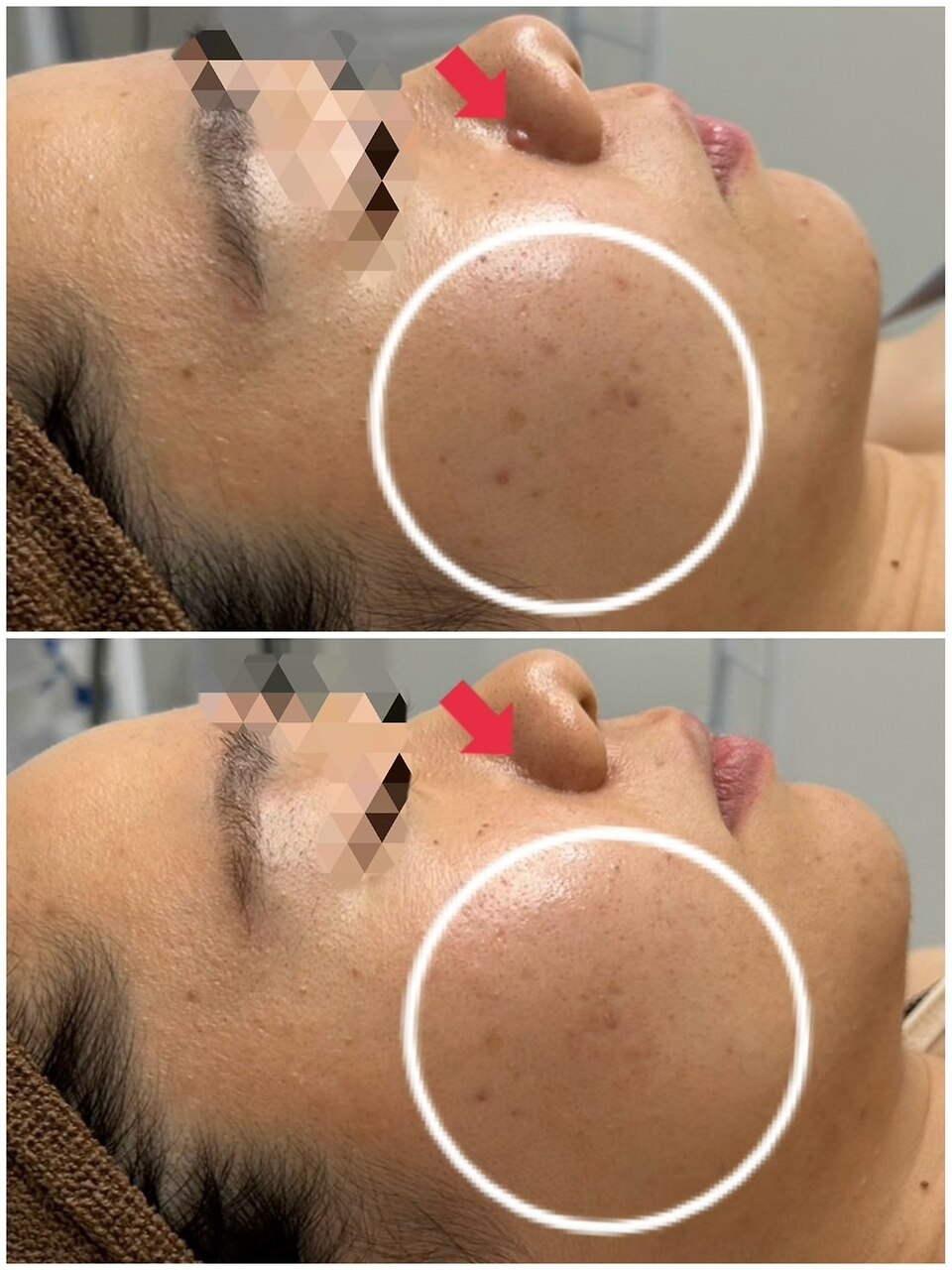 新潟市で毛穴ケアが人気のエステサロン｜ホットペッパービューティー