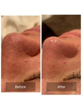 リジュベ(Rejuve)/毛穴/毛穴洗浄/船橋エステ/男性