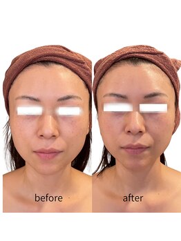 エン(EN)/小顔になりたい