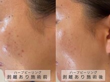 育肌美研 自由が丘サロン/ニキビケア｜ハーブピーリング