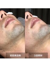 リムル(REMURU)/ひげ脱毛3回照射