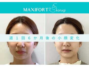 コルギ専門店 マキシフォート 栄店(Maxifort)/週1回6ヶ月後の小顔変化