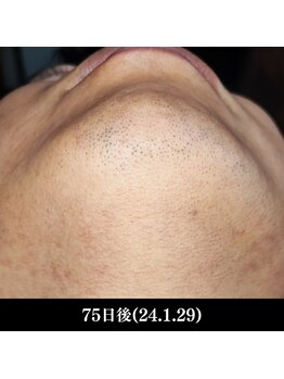 レイ(R.E.I)/【脱毛アフター】あご下・首