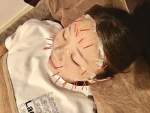 つつじが丘整骨院鍼灸マッサージ院/ヒト幹細胞パック×美容鍼