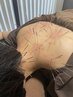 【コリ撃退】ルート部分鍼30分＋整体もみほぐし30分　¥10000