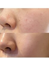 サロン リュンヌ(salon lune)/エクストラクション、プラズマ光