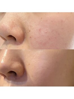 サロン リュンヌ(salon lune)/エクストラクション、プラズマ光