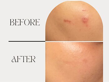 ニコリ(NICOLI)/ダメージ跡にも対応