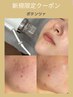 【毛穴改善&ハリUP】ポテンツァ(RFマイクロニードルリフト)¥16000