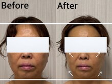 ベール(BEHL)/コルギのBefore After