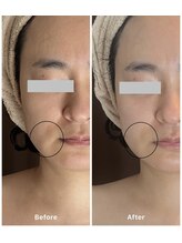 リベルタ/口横の変化/ツヤ肌