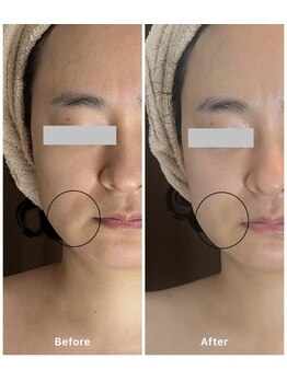 リベルタ/口横の変化/ツヤ肌