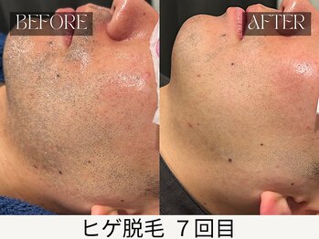 スキンジム(SKIN GYM)/青髭解消で顔色もパッと明るく