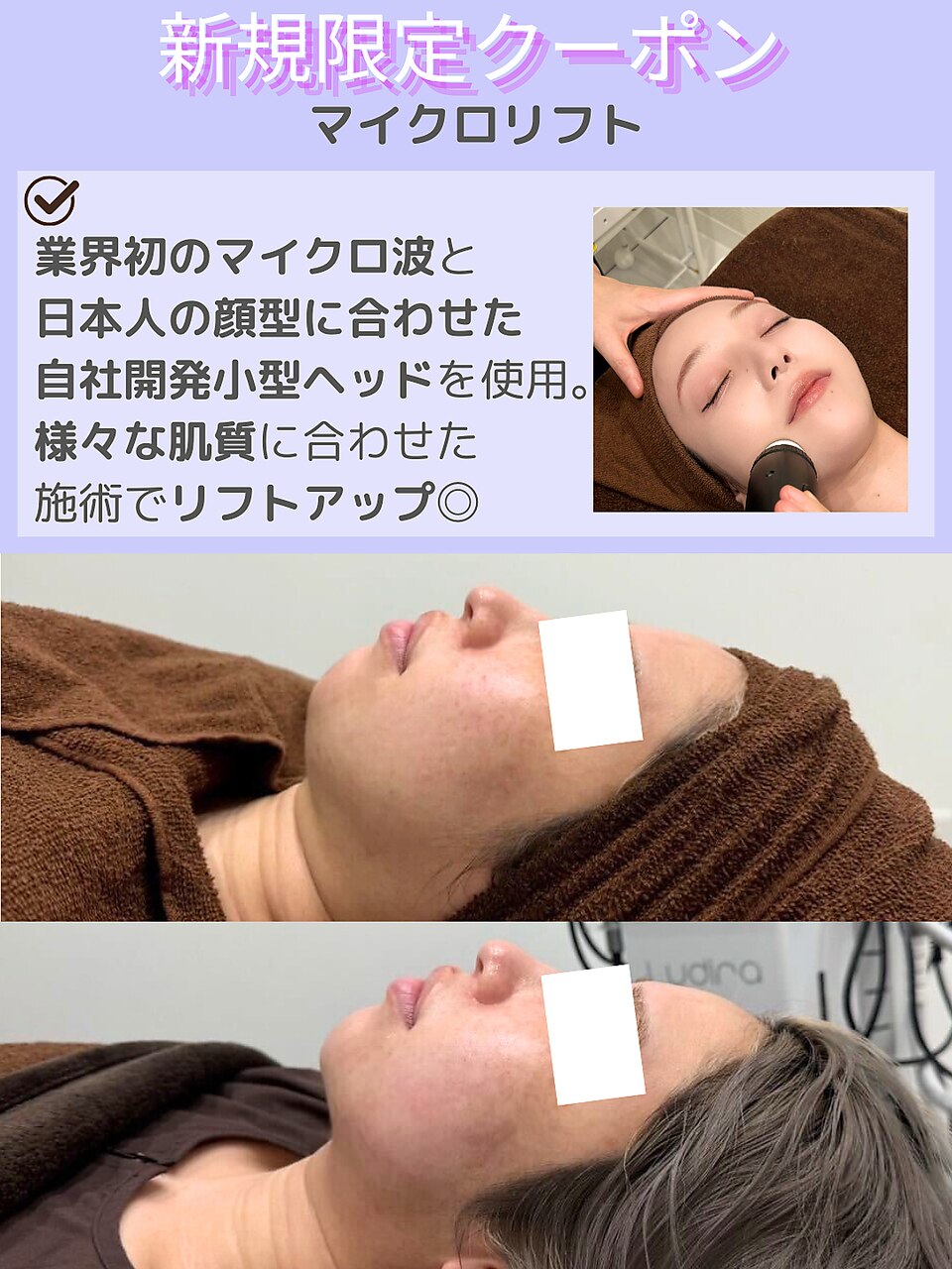 【二重あご/顔の脂肪】すっきり引き締まった小顔へ｜マイクロ波リフト