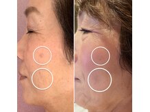 コンシーラーでも隠れなかったシミが1度の施術でシミ0の状態に！