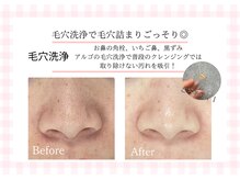 アルゴ 熊本宇土店(ALGO)/いちご鼻卒業！毛穴洗浄！