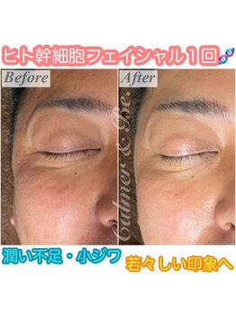 カルマーアンドビー(Calmer & Be.)/【ヒト幹細胞】Before/After