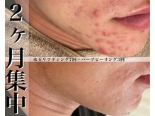 ヴェアリー 広尾(VARY)の雰囲気（ニキビケア人気NO1。結果が早くほしい方にハーブピーリングが◎）