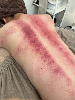 エービューティーサロン 松山店(A BEAUTY SALON.)の写真/【慢性疲労・コリ】１度で楽に動ける体へ！ラジオ波吸引マシンで全身のコリ・むくみをくまなく流します。