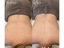 ハル(haru)/ビフォーアフター