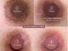 問い合わせ多数！【韓国式最新メラニンケア】あらゆるボディの黒ずみ色素除去
