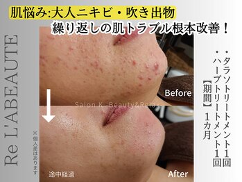 サロン ケイ(Salon K)/繰り返し大人ニキビ ケア