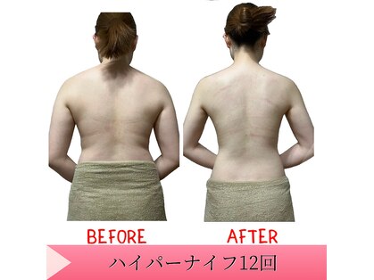 脱毛 痩身ぴゅあらの写真