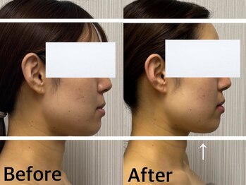 ベール(BEHL)/コルギのBefore After